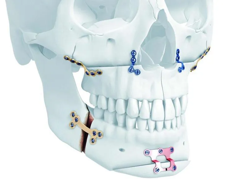 CMF Locking Plate System