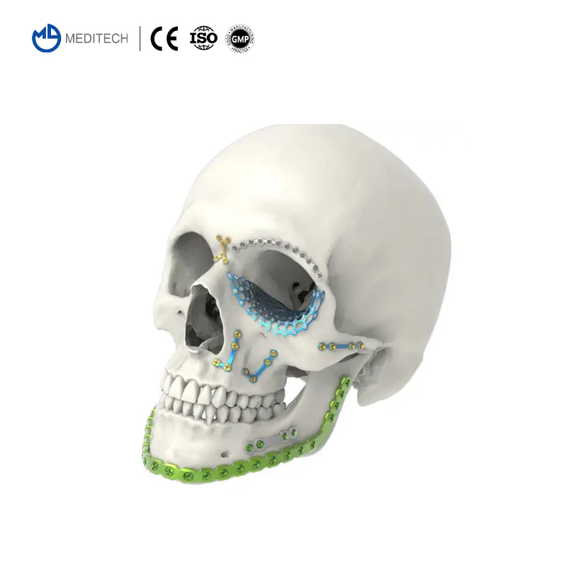 Titanium Cmf Locking Plates and Screws-Maxillofacial Orthopedic Implant System