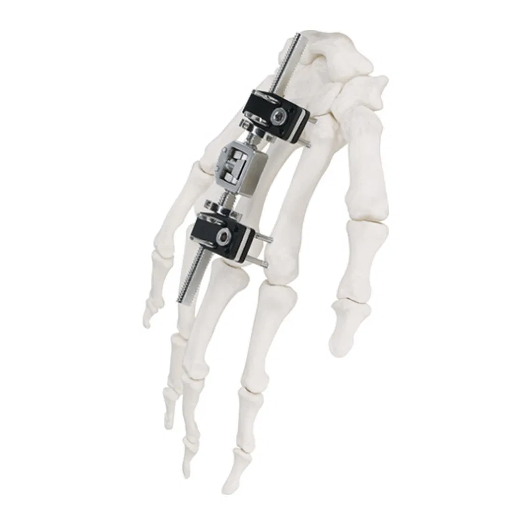 Finger Mini-Fixator Detailed View 2