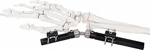 External Fixator for Bone Fixation, White &amp; Black, Titanium Alloy Design