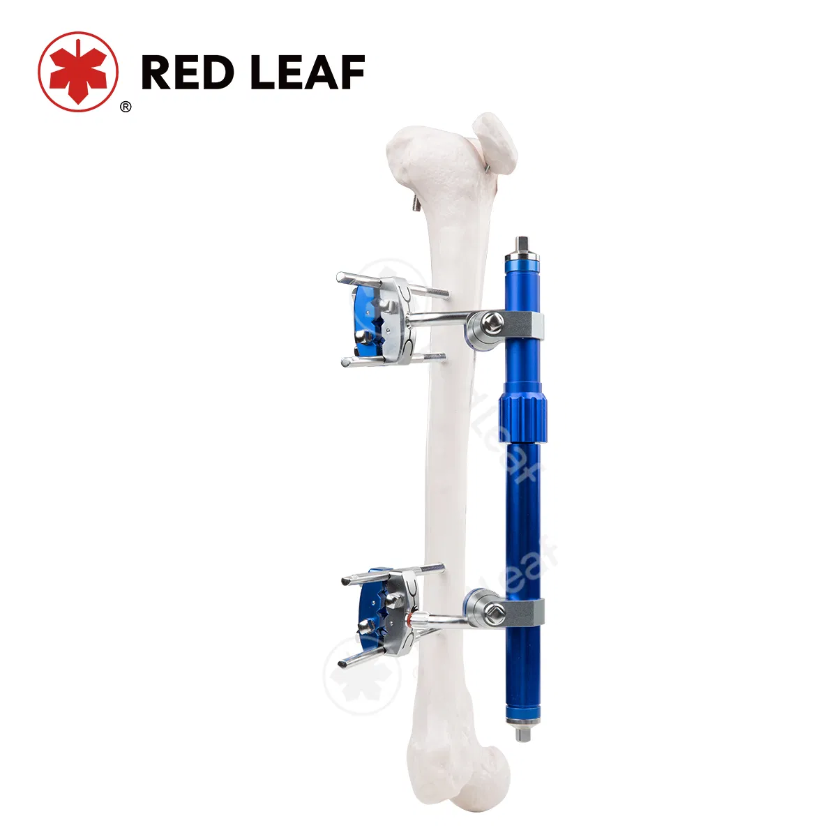 Surgical Femur Fixation Device Orthopedic External Fixator for Thighbone Trauma Recovery