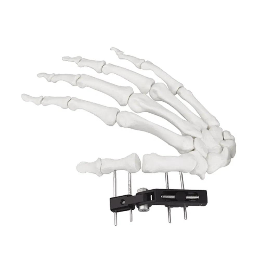 External Fixator Hand Bone Pin Stent Radius Mini Fixator Track Vertical Axis Type