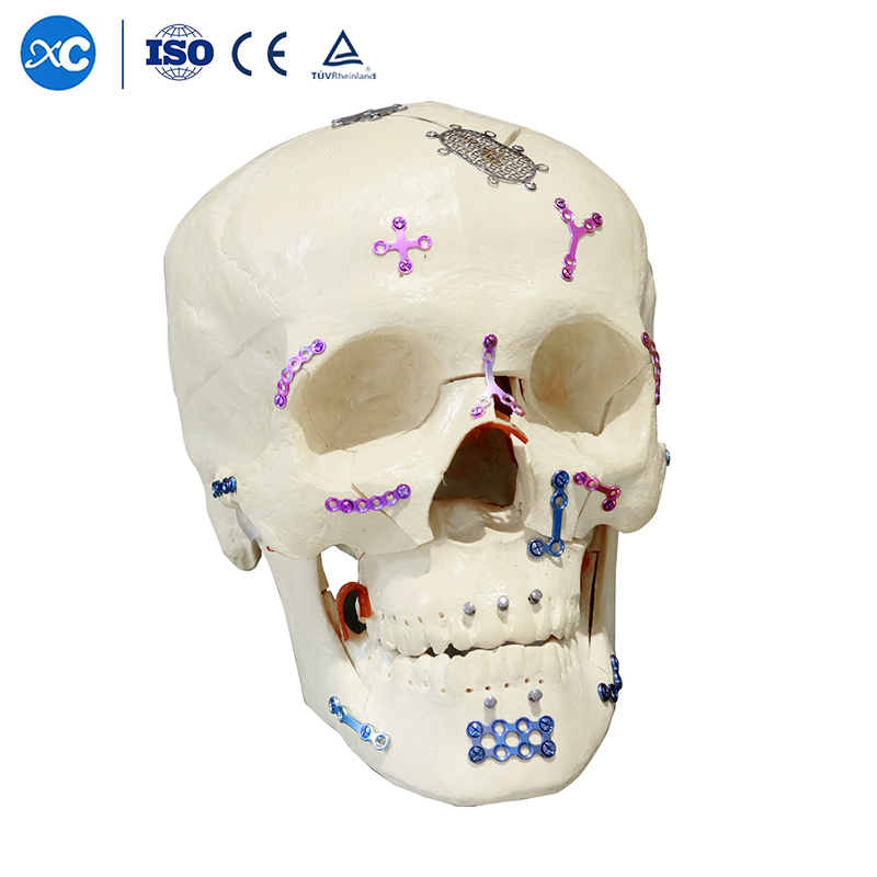 Surgery Kit Skull Reconstruction Titanium Maxillofacial Locking Plate and Screw Implants
