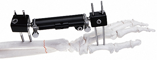 External Fixator, White &amp; Black, for Bone Fixation, Titanium Alloy &amp; Steel