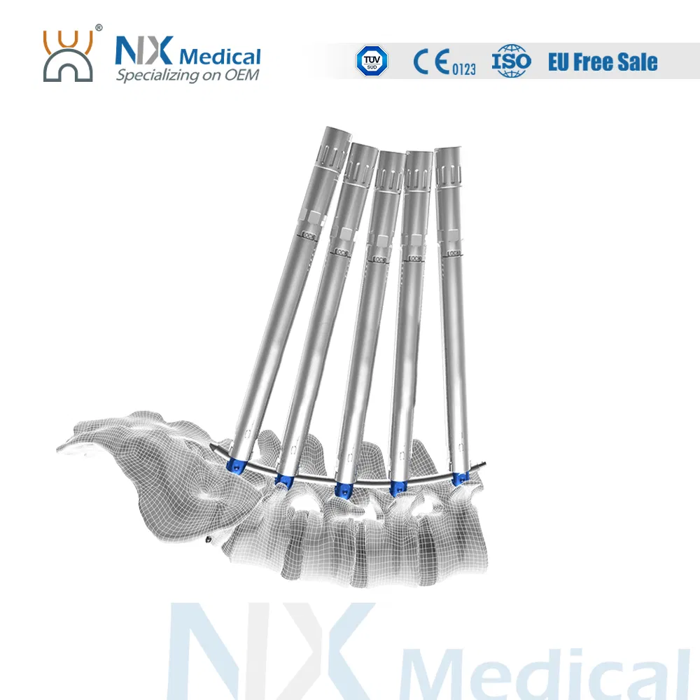 Nx Medical Spine Implant Cannulated Bone Cement Pedicle Screw for Spine Deformity