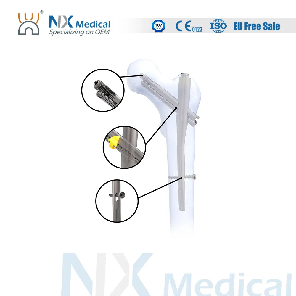 Nx Medical Pfia Nail Titanium Interlocking Intramedullary Femoral Nail for Bone Fixation