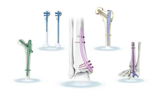 Orthopedic Expert Reversed Femoral Intramedullary Nail View 1