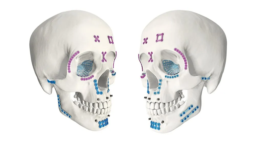 Maxillofacial Plate Detail
