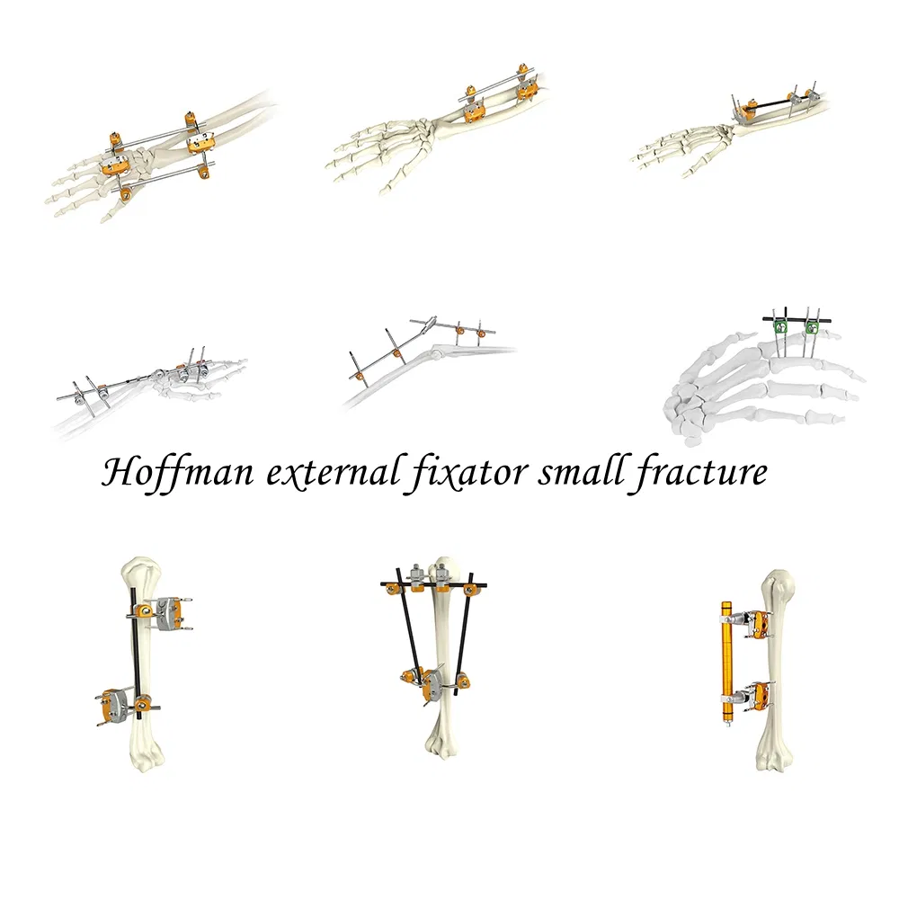 Related External Fixator Products