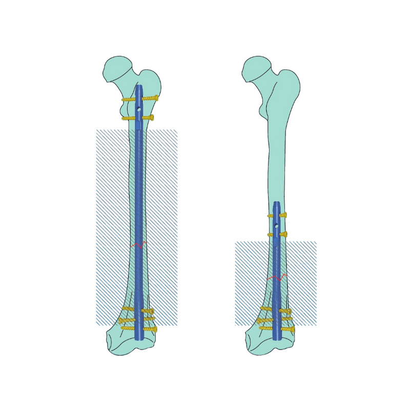 Czmeditech Orthopedic Expert Reversed Femoral Intramedullary Nail