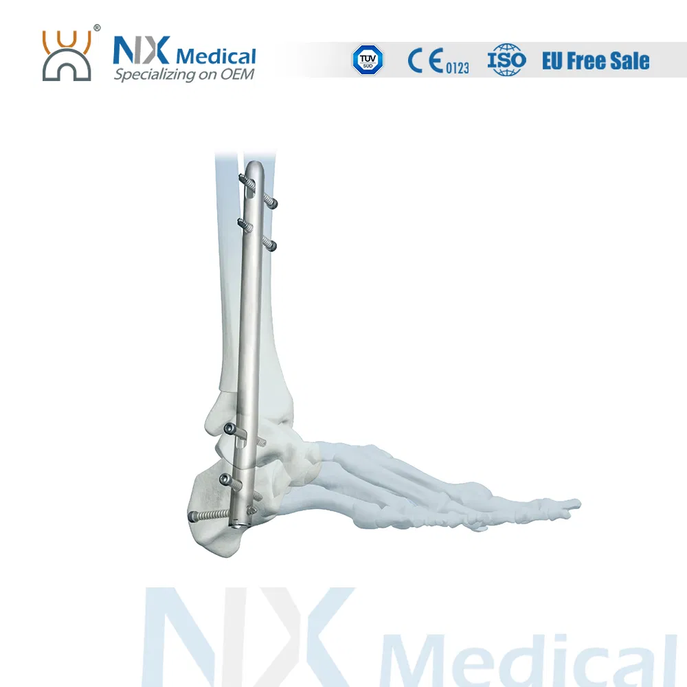 Nx Medical Titanium Orthopedic Orthopaedic Foot Ankle Fusion Intramedullary Nail