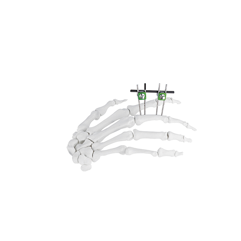 Hoffman Combination Mini Finger&Palm External Fixator