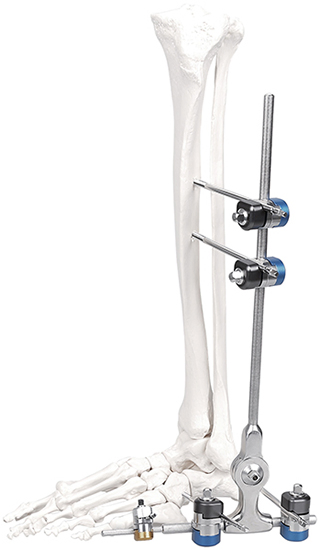 Orthopedic Stainless Steel Femur Fixator