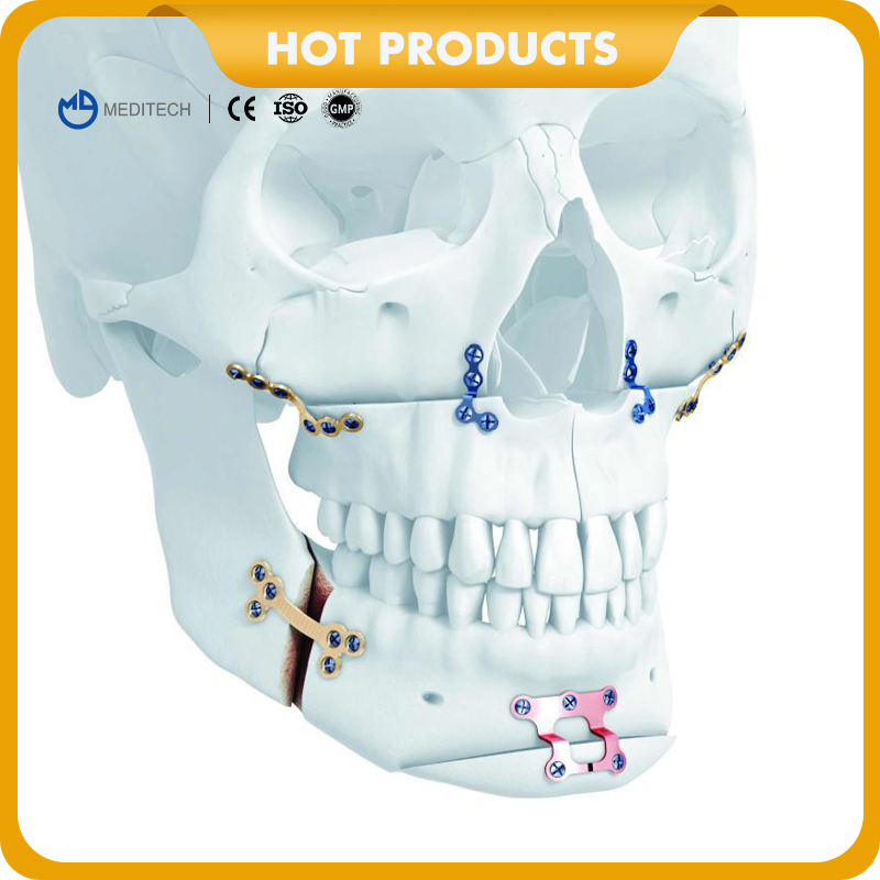 Titanium Cmf Locking Plates and Screws-Maxillofacial Orthopedic Implant System