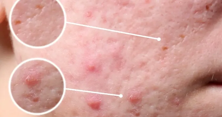 Adapalene Application