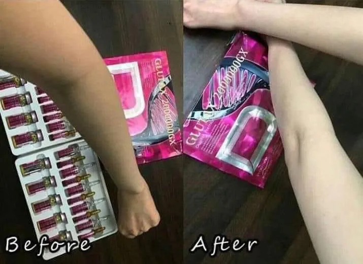 Glutathione Injection