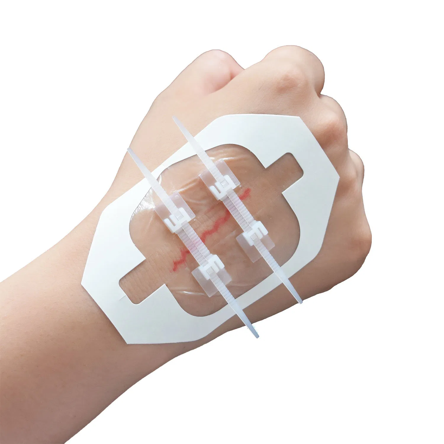 Adhesive Closure Zipper Wound Dressings with Zip Stitch