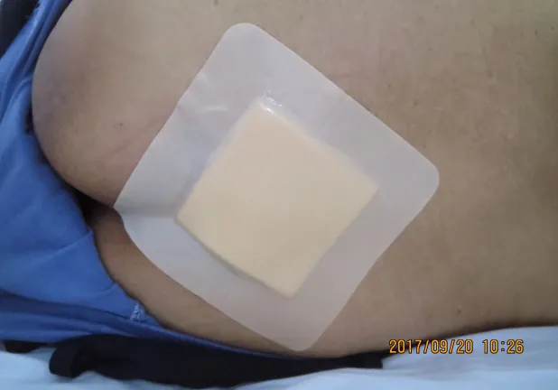 Wound Dressing Detail 1