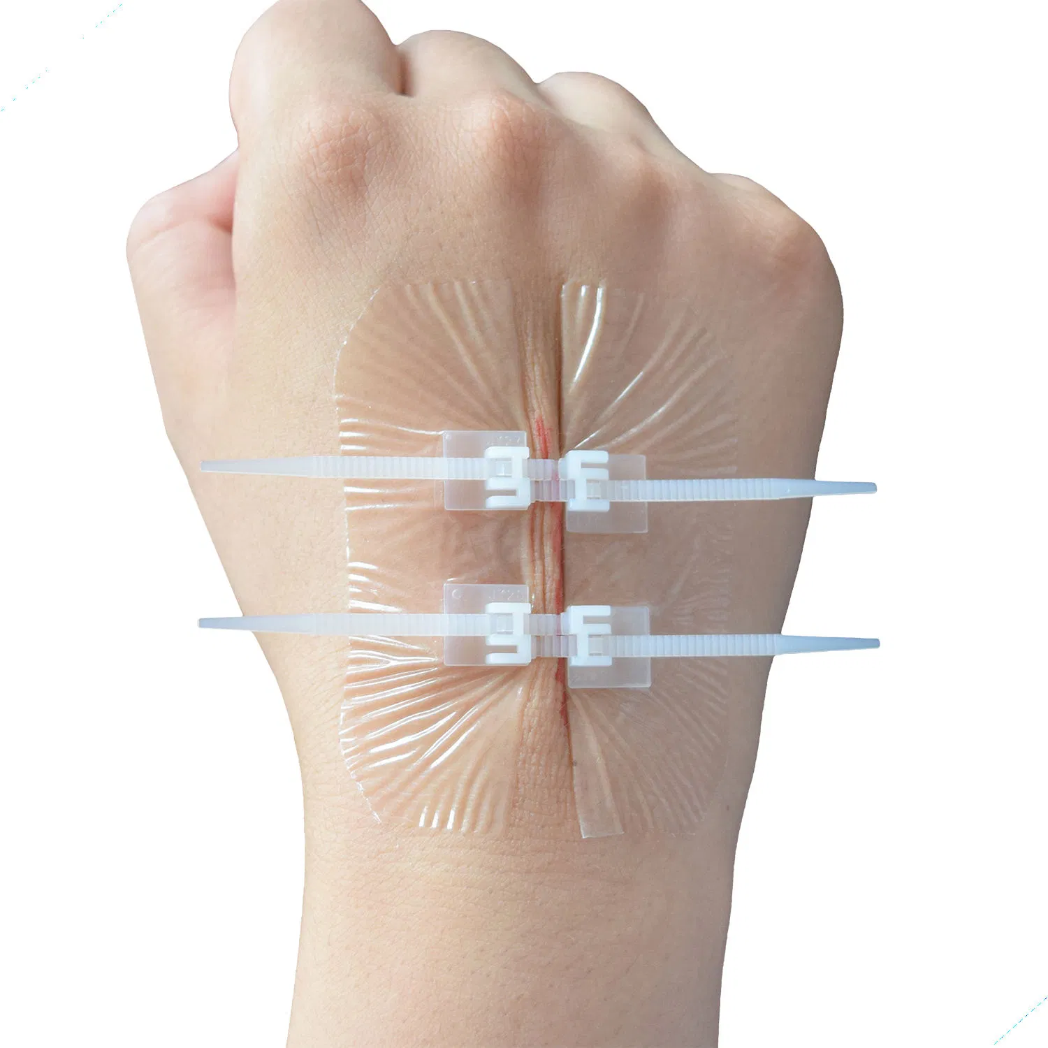 Adhesive Closure Zipper Wound Dressings with Zip Stitch