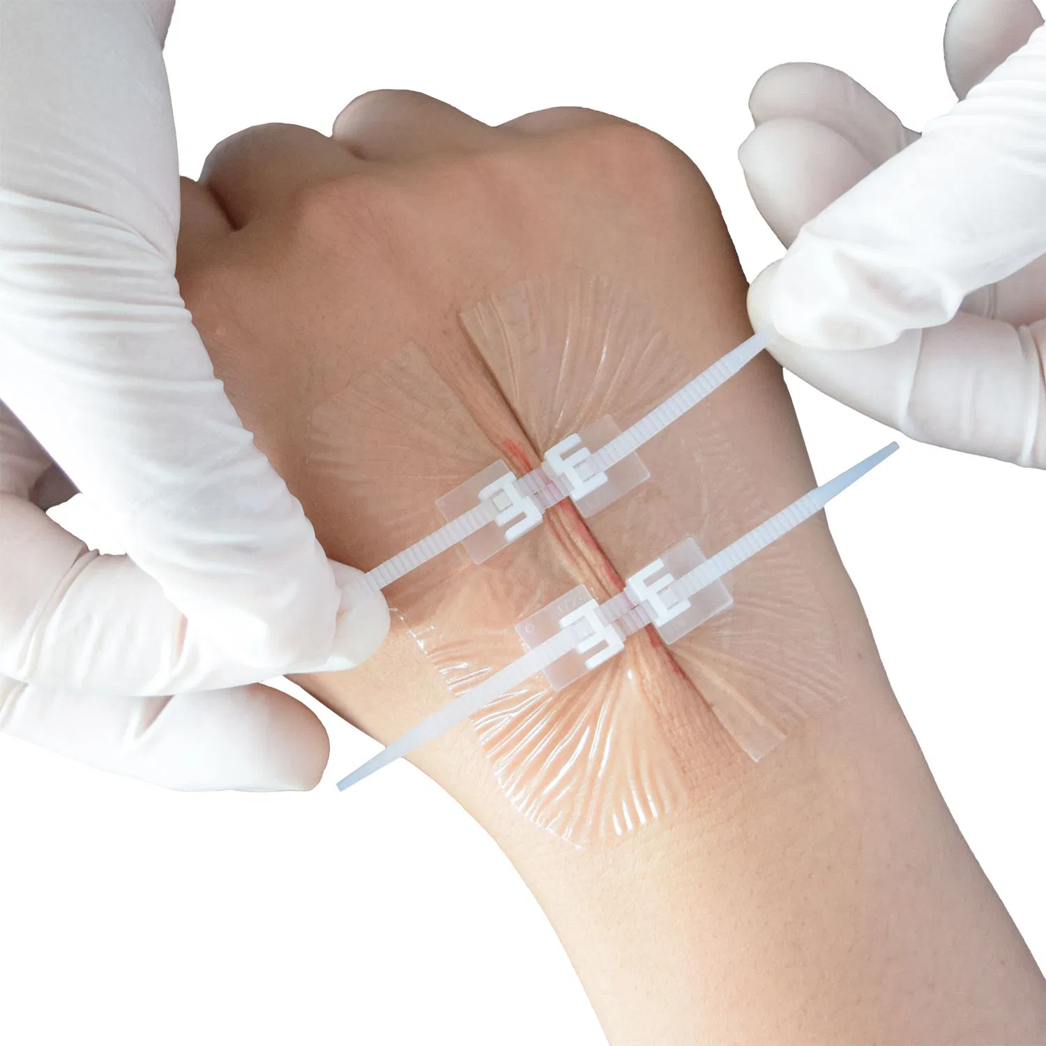 Adhesive Closure Zipper Wound Dressings with Zip Stitch