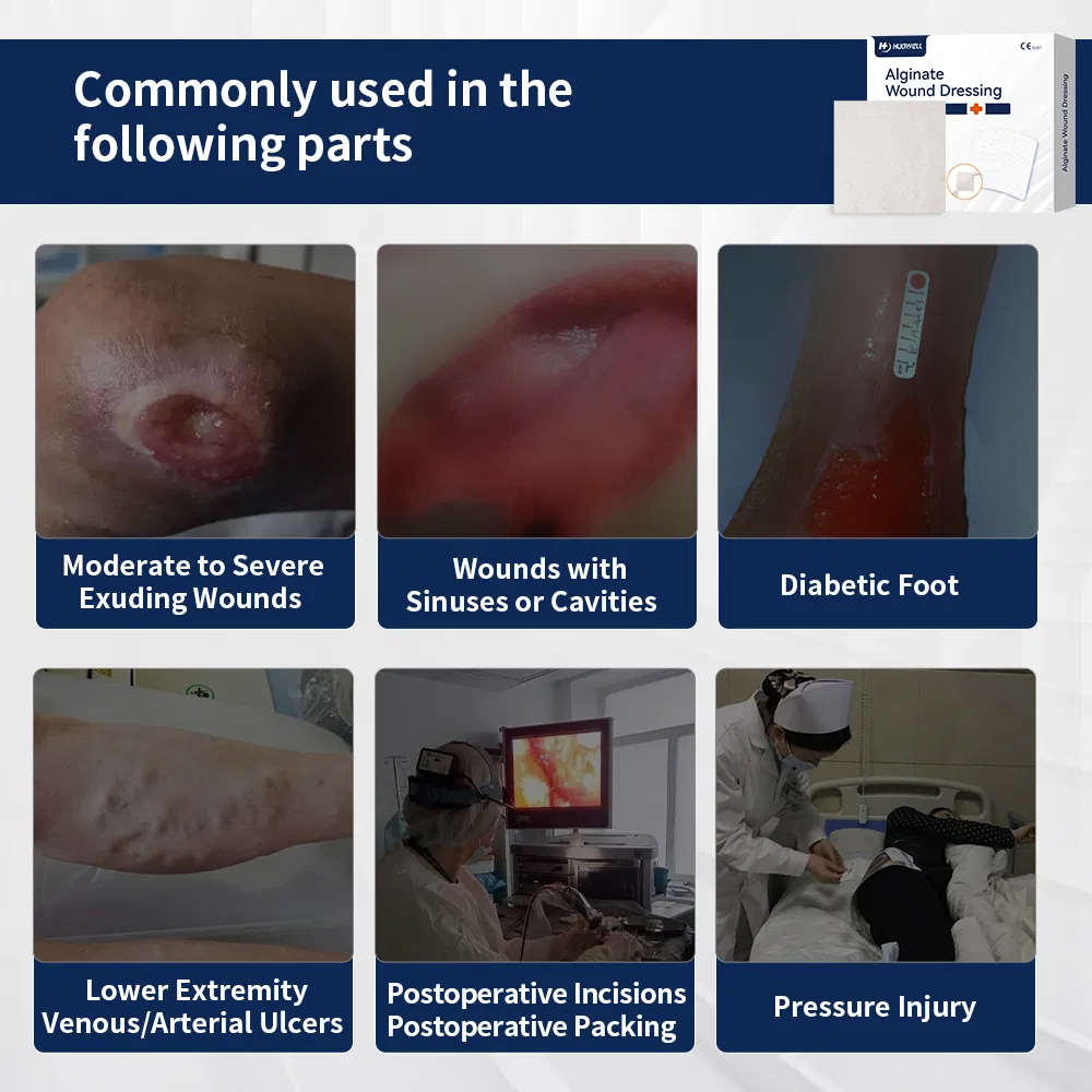 Self-Adhesive Medical Antibacterial Wound Dressing Calcium Alginate Dressing with Silver Antimicrobial Wound Care Dressing