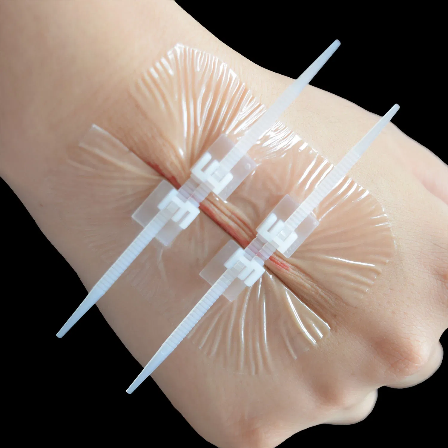 Adhesive Closure Zipper Wound Dressings with Zip Stitch