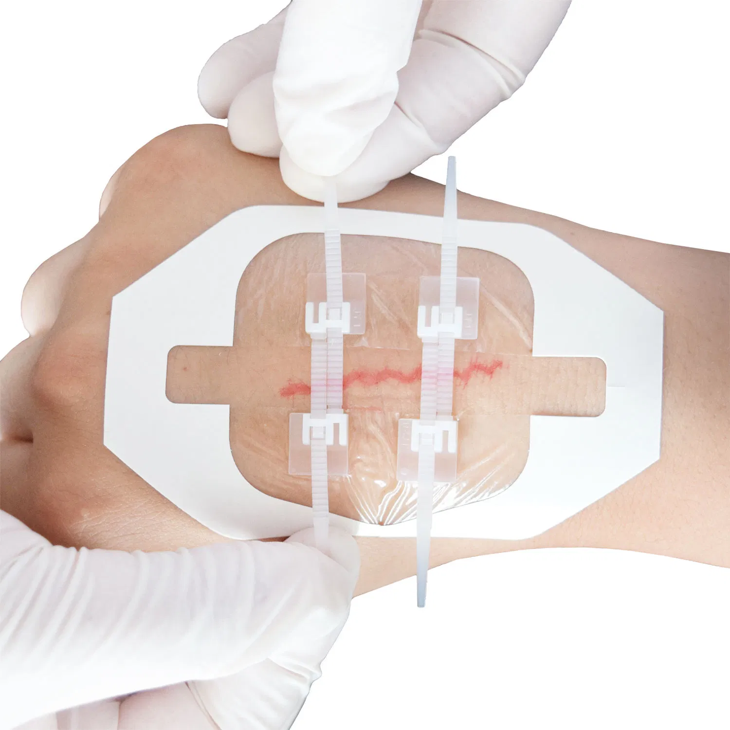 Adhesive Closure Zipper Wound Dressings with Zip Stitch