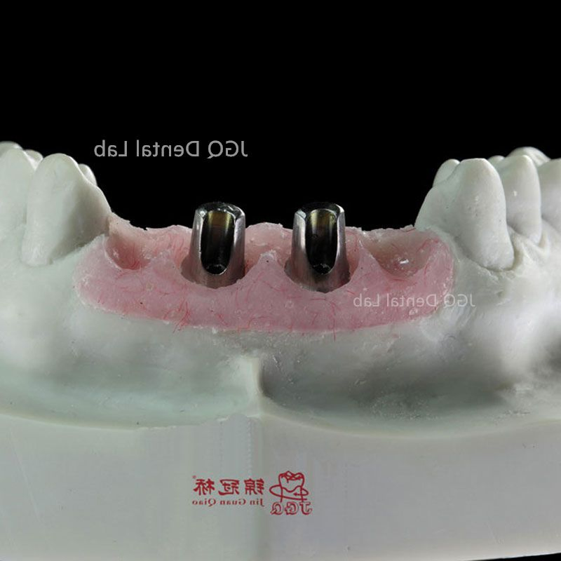 Dental Products Suppliers Customized Titanium Base and Fixed Zirconia Dentures Supported for Dental Implant