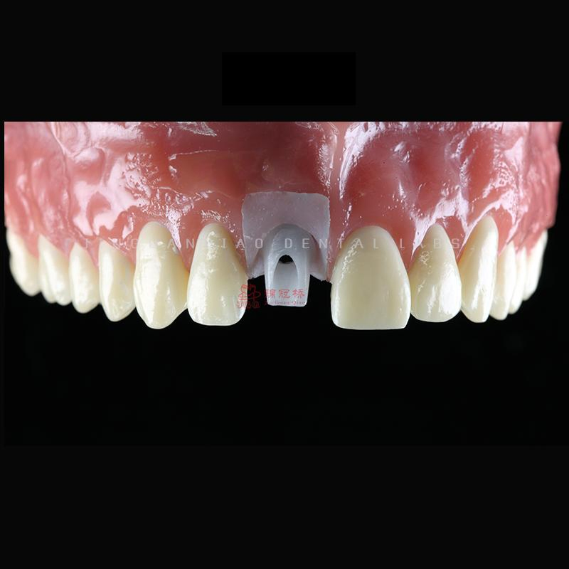 All on Dental Implants with Zircornia Abutment Dental Implant Titanium Bridges and Screwed Crowns