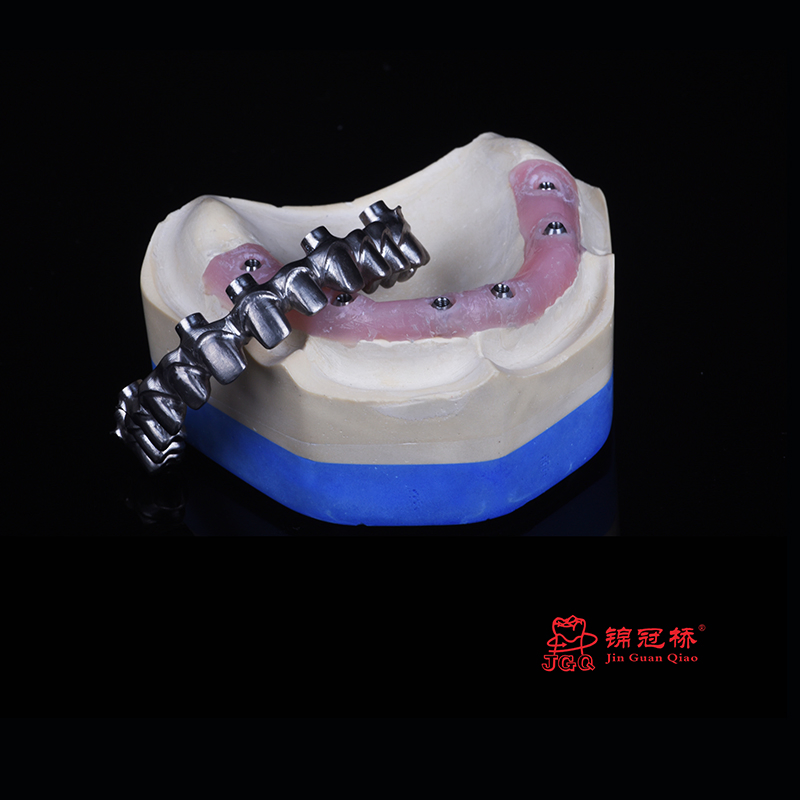 3D Digital Titanium Framework for Dental Implant Supported
