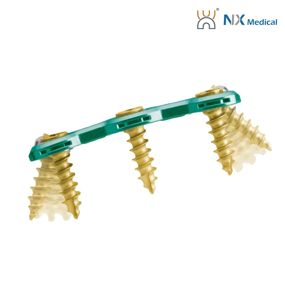 Nx Medical Premium Titanium Anterior Cervical Plate System Orthopedic Spine Implant