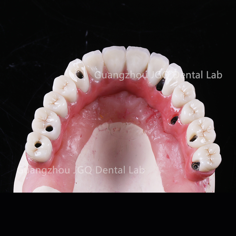 3D Digital Titanium Framework for Dental Implant Supported