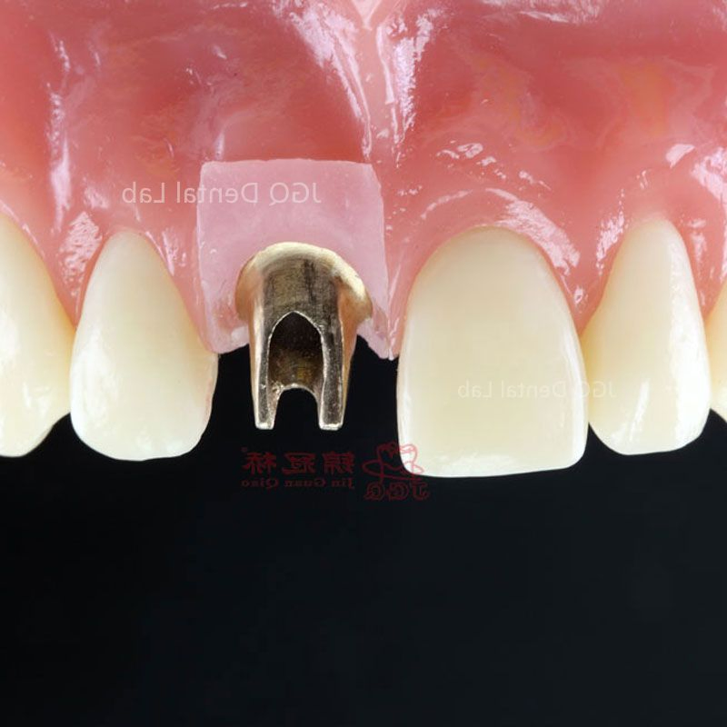 Dental Products Suppliers Customized Titanium Base and Fixed Zirconia Dentures Supported for Dental Implant