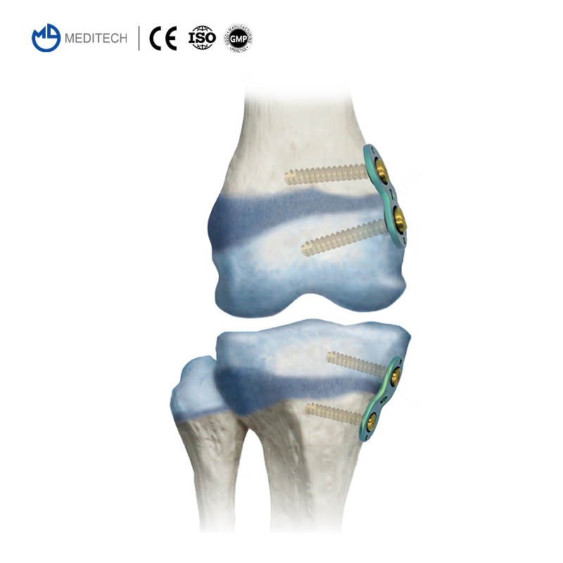 Orthopedic Implant Titanium Compression Locking Plate Pediatric Eight-Plate Guided Growth