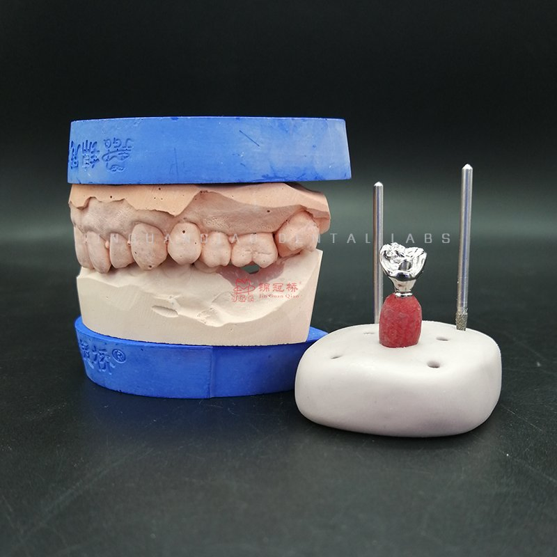 China Dental Lab Supply Dental Products Implant Dentures with Customized Titanium Abutment