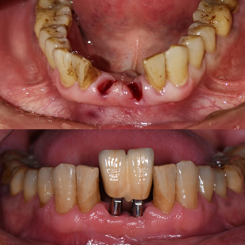 Dental Lab China Custom Implant Front Zirconia Teeth Titanium Abutment 3 Days in Lab