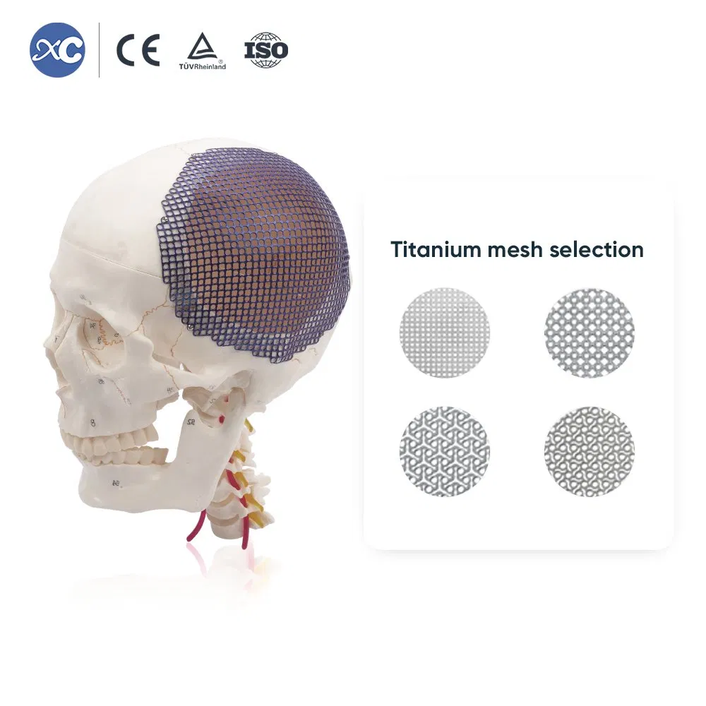 3D Flower Shape Titanium Neurosurgery Cranial Skull Maxillofacial Mesh