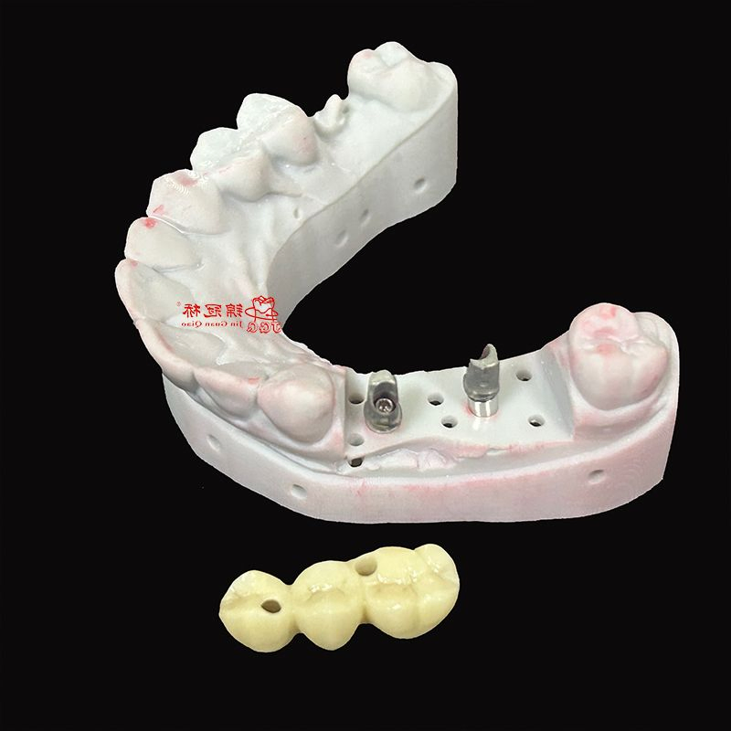China Dental Lab Supply Dental Products Implant Dentures with Customized Titanium Abutment