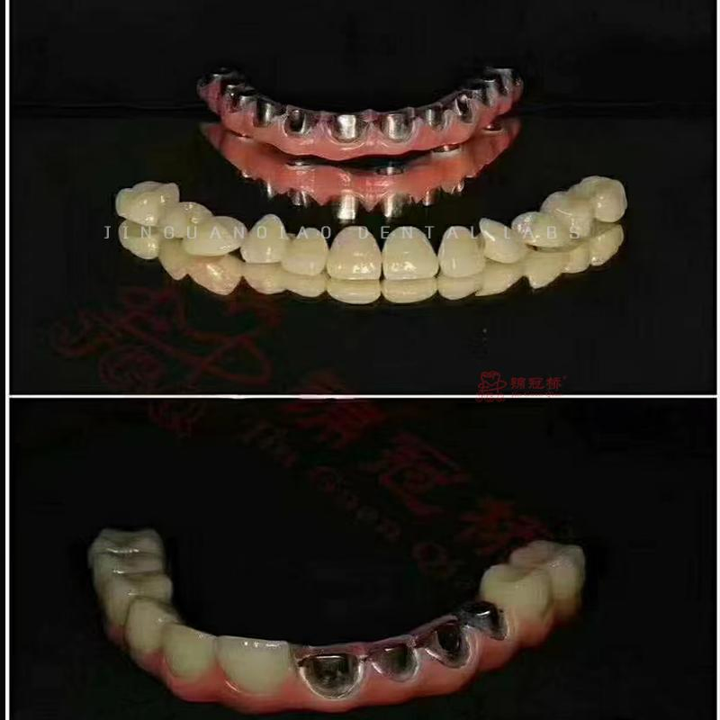 Dental Implant Hybrid Dentures with Titanium Bridge and Screwed Zircornia Crowns Lab China