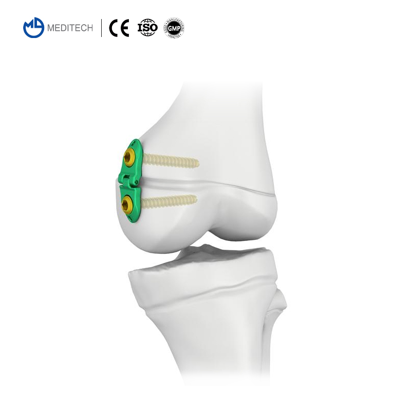 Orthopedic Implant Titanium Compression Locking Plate Pediatric Eight-Plate Guided Growth