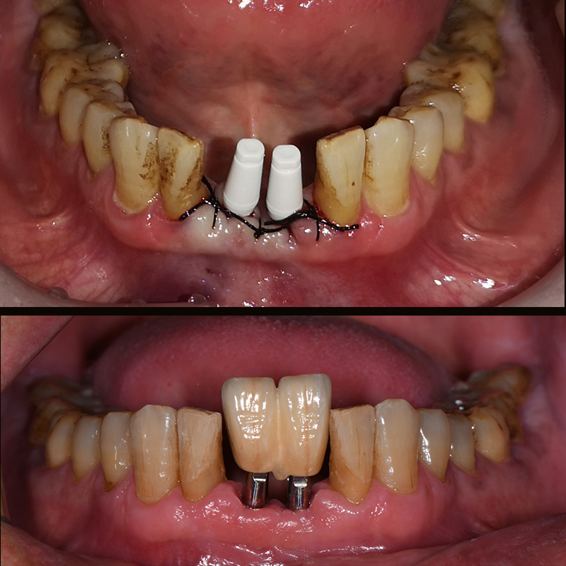 Dental Lab China Custom Implant Front Zirconia Teeth Titanium Abutment 3 Days in Lab