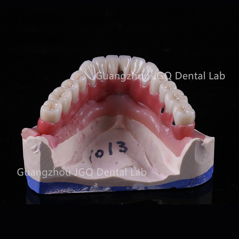 3D Digital Titanium Framework for Dental Implant Supported