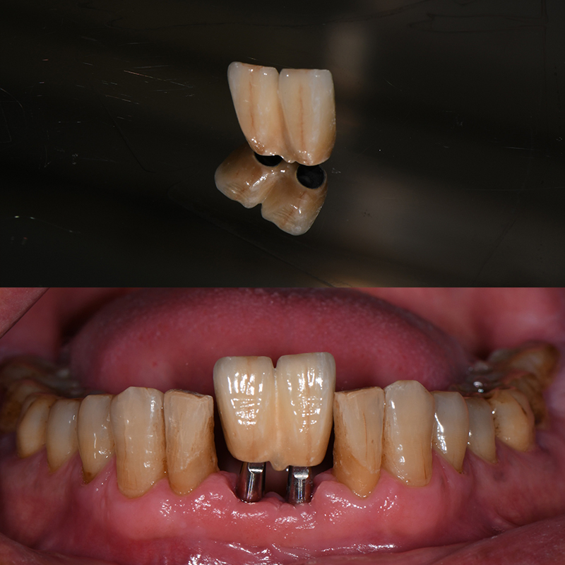 Dental Lab China Custom Implant Front Zirconia Teeth Titanium Abutment 3 Days in Lab