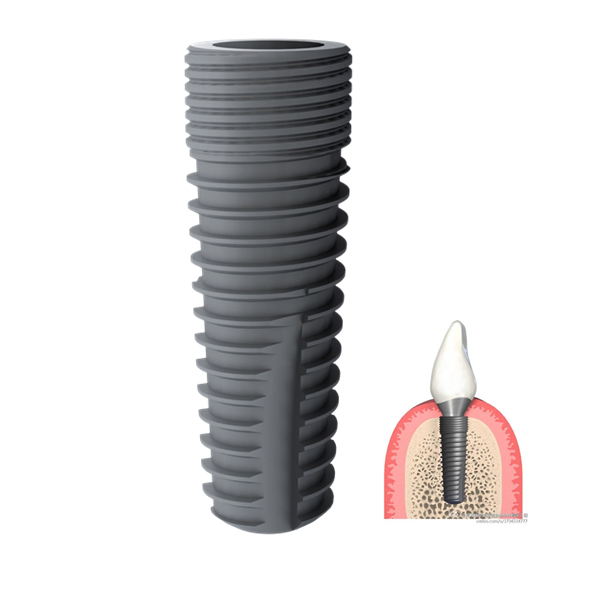 High Precise Dental Implant Pure Titanium OEM Tooth Fixture