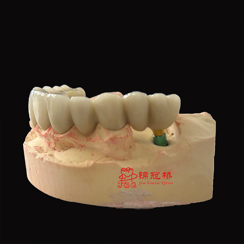 Dental Implants Cutomized Titanium Abutment with Pfm Bridges Restore Natural Bite Force and Chewing Function