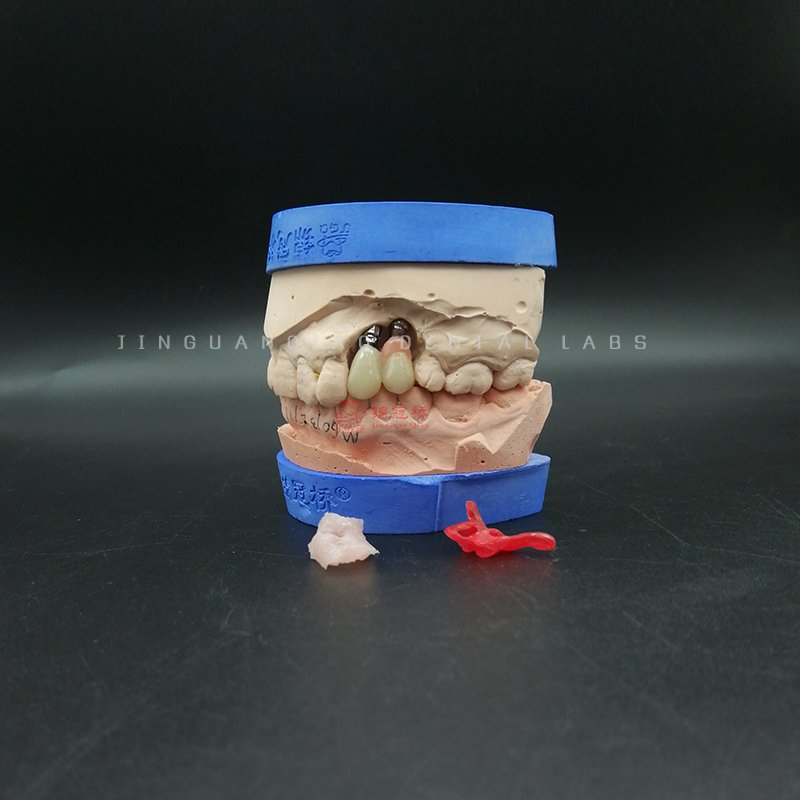 China Dental Lab Supply Dental Products Implant Dentures with Customized Titanium Abutment