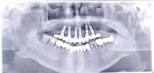 Wego Dental Implant Drape Packs Available Inexpensive Dental Implants