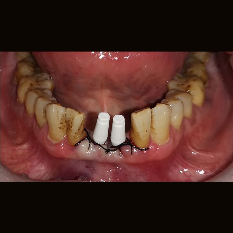 Dental Lab China Custom Implant Front Zirconia Teeth Titanium Abutment 3 Days in Lab