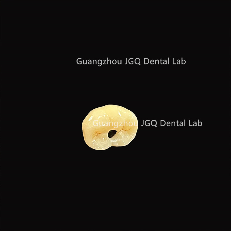 Dental Implant Zirconia Crown and Titanium Abutment Competitive Price Dental Lab Manufacture
