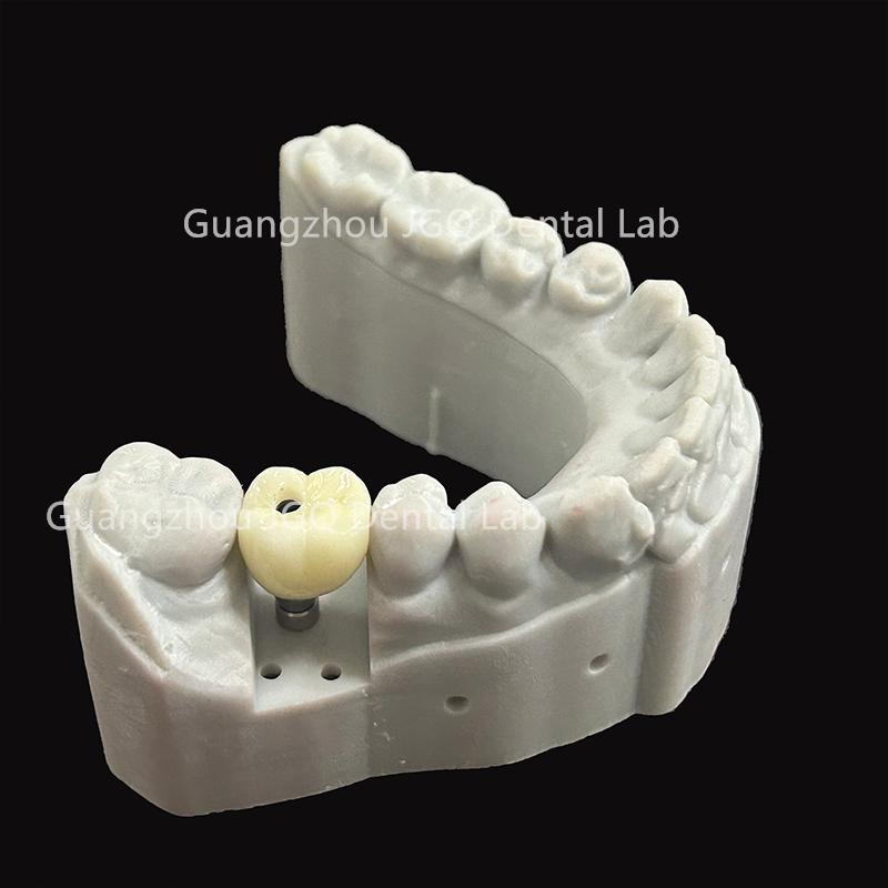 Dental Products Suppliers Customized Titanium Base and Fixed Zirconia Dentures Supported for Dental Implant